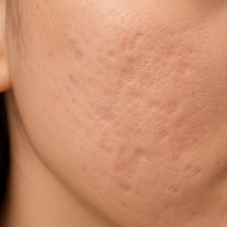 Acne Scarring