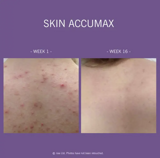Skin Accumax®